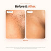 Vaginal Ingrown Hair Serum