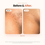 Vaginal Ingrown Hair Serum